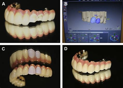 Management Of Implantprosthodontic Complications Pocket Dentistry