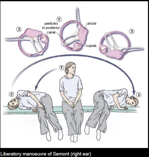 Study Notes Bppv Benign Paroxysmal Positional Vertigo