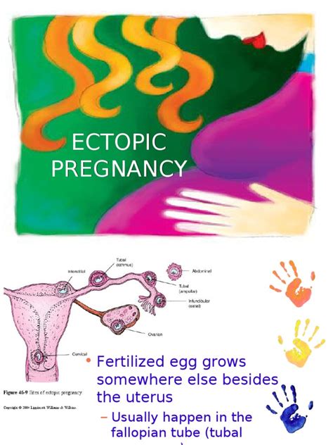 Ectopic Pregnancy Pdf Fertility Pregnancy