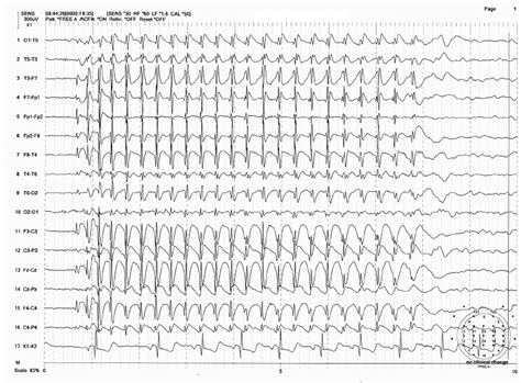 Eeg Interpretation In Childhood Epilepsies Neupsy Key