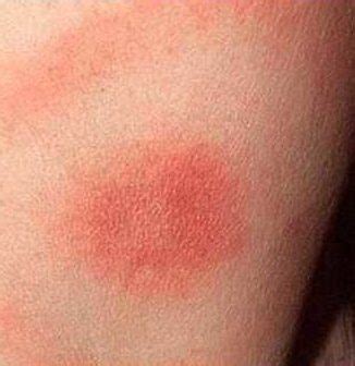 Maybe you would like to learn more about one of these? Is this red rash ringworm or dermatitis? | Ask A Doctor Free | Best Answers, Reviews ...