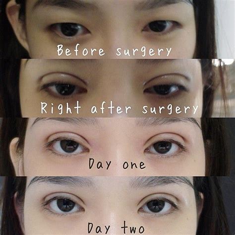My double eyelid surgery experience | Eyelid surgery ...