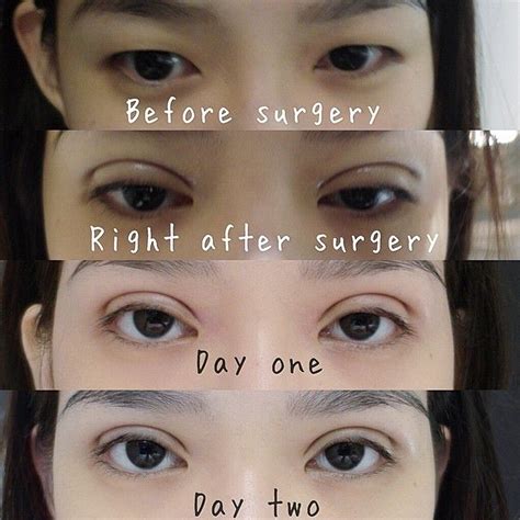 Rosenthal, m.d., f.a.c.s eyelid surgery in new york is a common procedure that can reduce the puffiness of your eyes. L I A N M E I T I N G : My double eyelid surgery ...