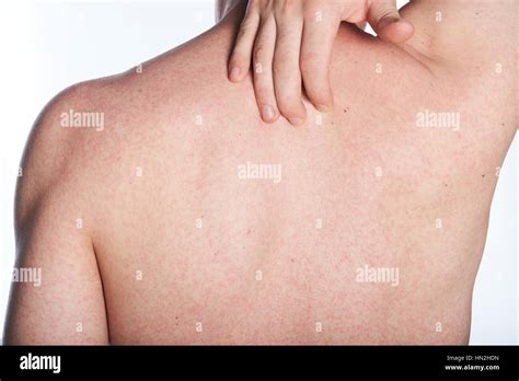 Allergy Rash On Back Of Man Isolated On White Stock Photo Alamy