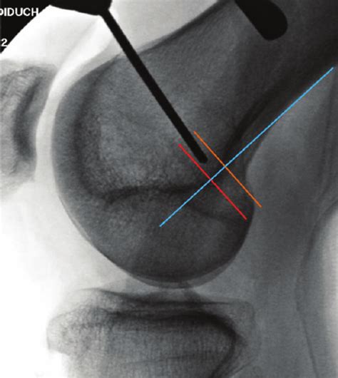 The Medial Patellofemoral Ligament Mpfl Attachment Is Defined In