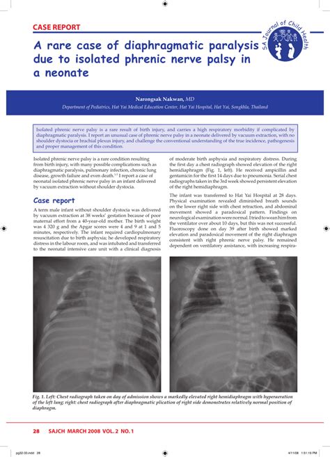 pdf a rare case of diaphragmatic paralysis due to isolated phrenic nerve palsy in a neonate