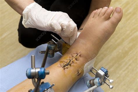 Surgical Wounds Infected With Mrsa Stock Image C0017300 Science