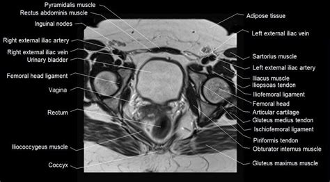 Pelvis Muscles Mri Anatomy Mri Female Pelvis Anatomy Axial Image Sexiz Pix