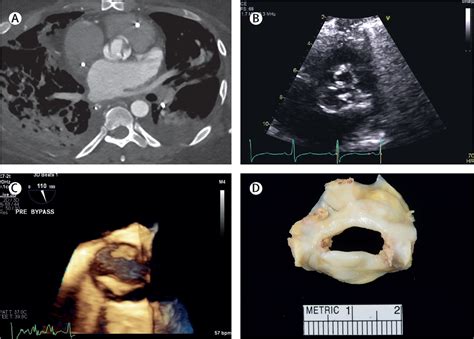 Bicuspid Or Unicuspid Aortic Valve That Is The Question In A 38 Year