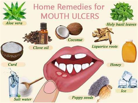 Mouth Ulcers Mouth Ulcers Mouth Sores Mouth Ulcer Treatment
