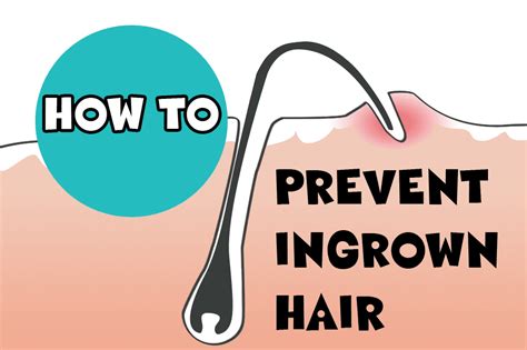 How To Properly Remove Ingrown Hair With Images Prevent Ingrown