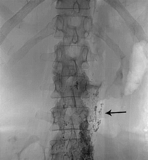 Figure 1 From Thoracic Duct Embolization For Nontraumatic Chylous