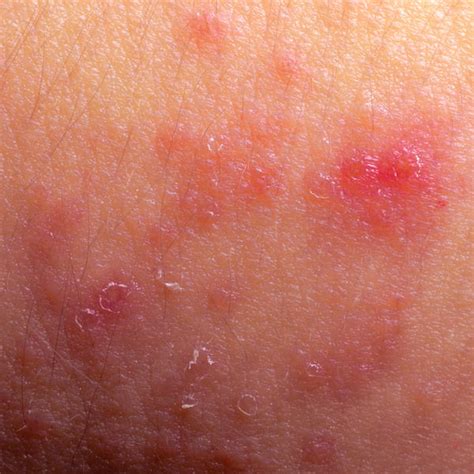 Do I Have Eczema Dorothee Padraig South West Skin Health Care