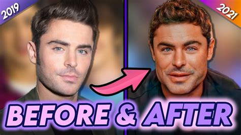 Zac Efron Before And After Why He Really Got Plastic Surgery Youtube