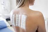 Atopy Patch Test With Aeroallergens for Allergen Diagnosis in Patients ...