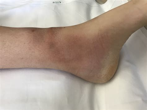 Erythema Nodosum In A Quiescent Phase Of Ulcerative Colitis The Foot