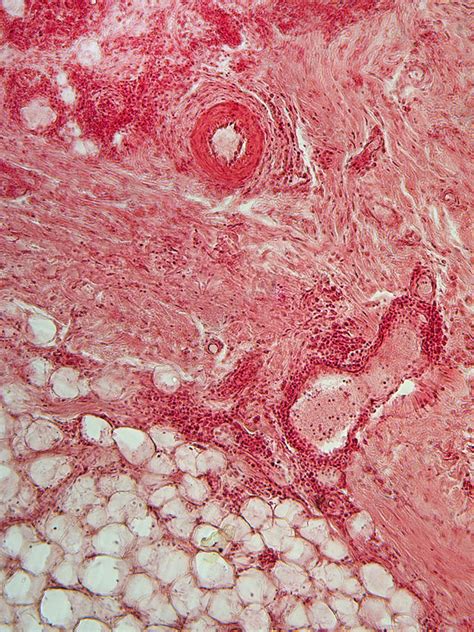 Lm Of Lupus Skin Lesion Stock Image C0174206 Science Photo Library