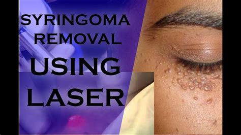 Laser Treatment For Syringoma Cost Burgard Kishaba99