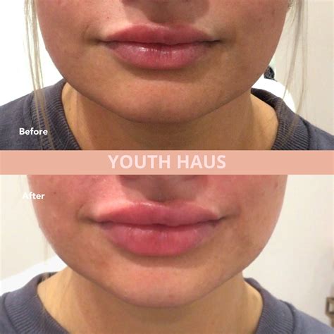 How To Reduce Swelling From Lip Injections