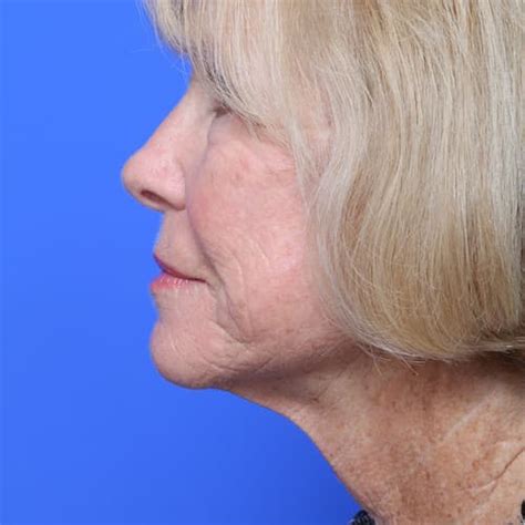 Neck Lift Surgery Columbia Md Baltimore Neck Lift