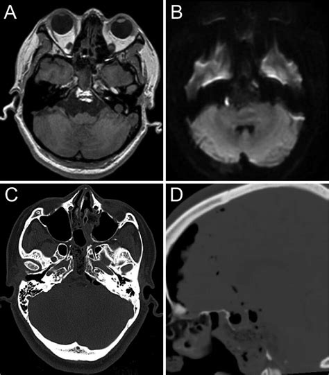 Endoscopic Endonasal Transclival Approach For A Ventral Brainstem