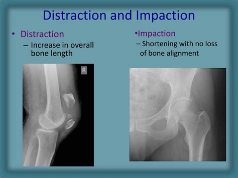 Ppt Radiology Of Fracture Principles Powerpoint Presentation Free