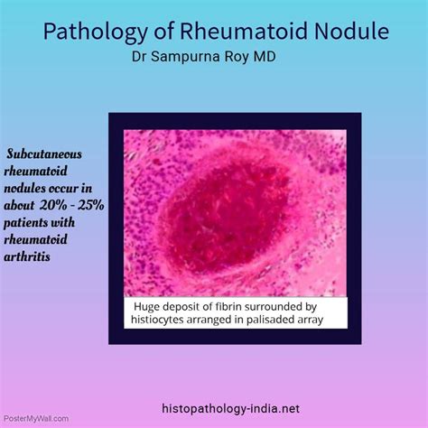 Pathology Of Rheumatoid Nodule Rheumatoid Nodules Pathology