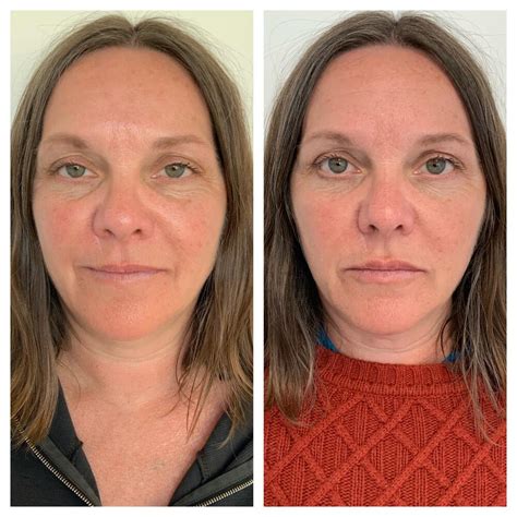 Dermal Fillers Before And After Patient 01 Refine Anti Aging Medicine