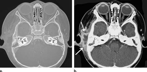 Acute Mastoiditis With Abscess In An 11 Month Old Girl With Otalgia And