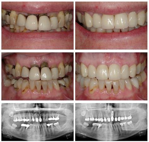 Restorative Dental Treatments Restorative Dentistry