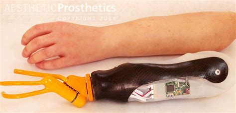Health Management And Leadership Portal Hand Prosthesis Upper