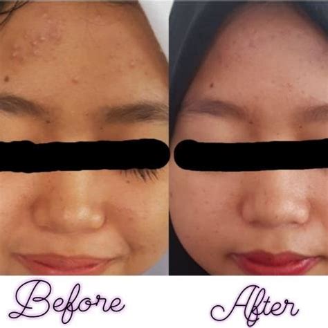 Before And After Application Of Honey On Moderate Acne Vulgaris Download Scientific Diagram