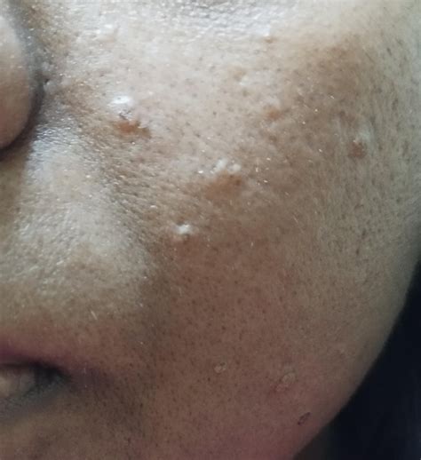 bumps cysts sebaceous filaments on face looking for suggestions on what to do r