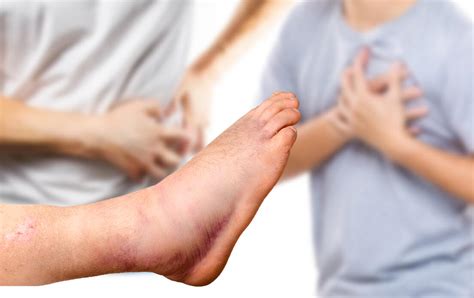 Left Foot And Ankle Swelling Symptoms Causes And Best Medication