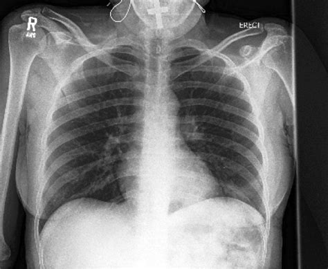 There is a degree of hyperinflation as evidenced by both increased retrosternal airspace and somewhat flattened and depressed diaphragms. AI system more accurately identifies collapsed lungs using ...