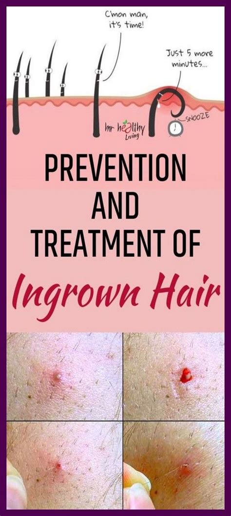 Infected Ingrown Hair Cyst Pictures Tips In Dealing With Ingrown