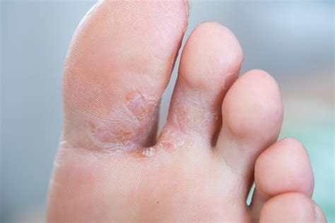 Skin Peeling Between Toes Causes And Treatment