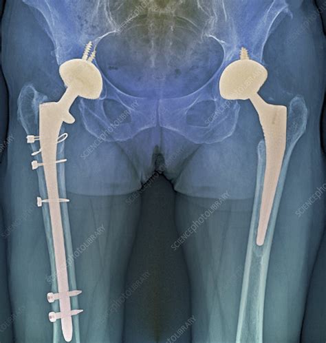Double Hip Replacement X Ray Stock Image C0026532 Science Photo Library