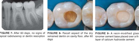 Pdf Indirect Pulp Treatment In A Permanent Molar Case Report Of 4