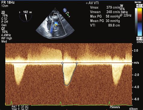 Echo Doppler Shows Aortic Stenosis With Pg 58 Mmhg And Pg 30 Mmhg With