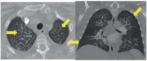 Pulmonary Edema Interstitial Radiology Key