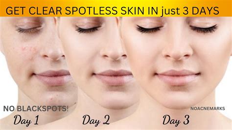 Clean And Clear Face In Just 3 Days Clear Skin Challenge Dark Spots