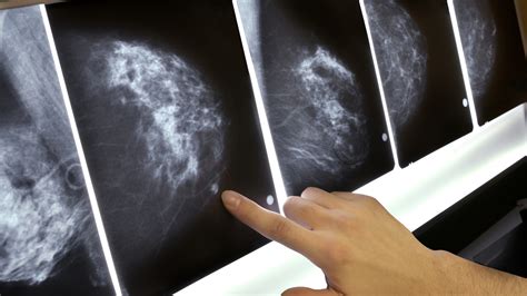 Got Dense Breasts That Can Depend On Who Is Reading The Mammogram