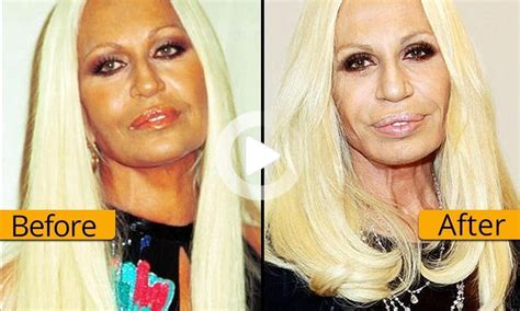 Celebrities Undergone Worst Plastic Surgery That Ruined Their Faces And