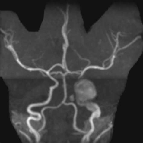 Mra Showing The Same Mm Left Cavernous Sinus Internal Carotid Artery