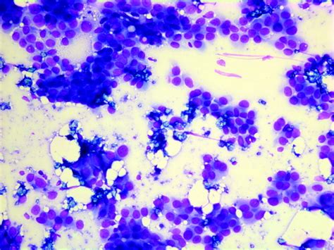 Cytologic Features Of Ductal Carcinoma In Situ In Fine‐needle