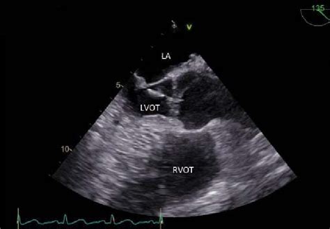 Transesophageal Echocardiography Aortic Valve Long Axisview 18 Mm Long