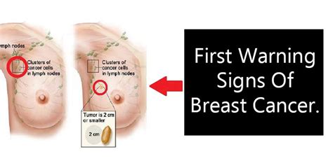 Breast cancer is easily treated and usually curable when detected in the earliest of stages. What are the first warning signs of breast cancer ...