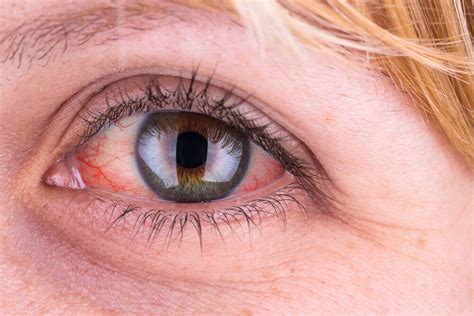 Why Are My Eyes Red And Bloodshot Causes And Treatment Ocuwellness