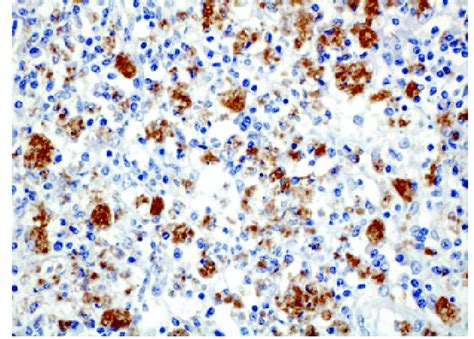 Macrophages Replete Of Bacilli In Intraparotid Lymph Node Download